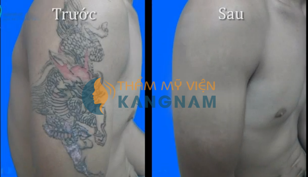 cach-xoa-vet-xam