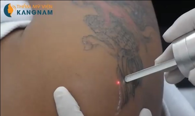 xóa hình xăm thẩm mỹ