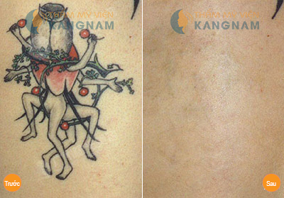 Laser Toning xóa xăm an toàn, hiệu quả