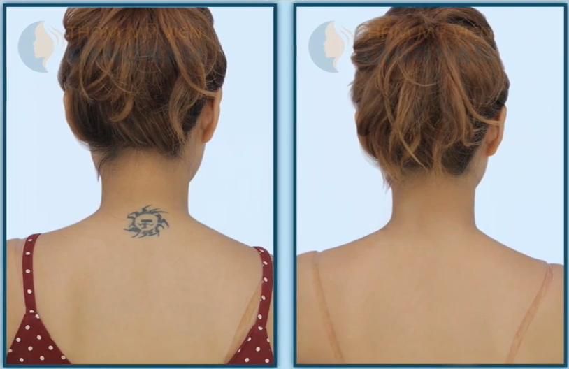 xóa xăm bằng Laser Toning