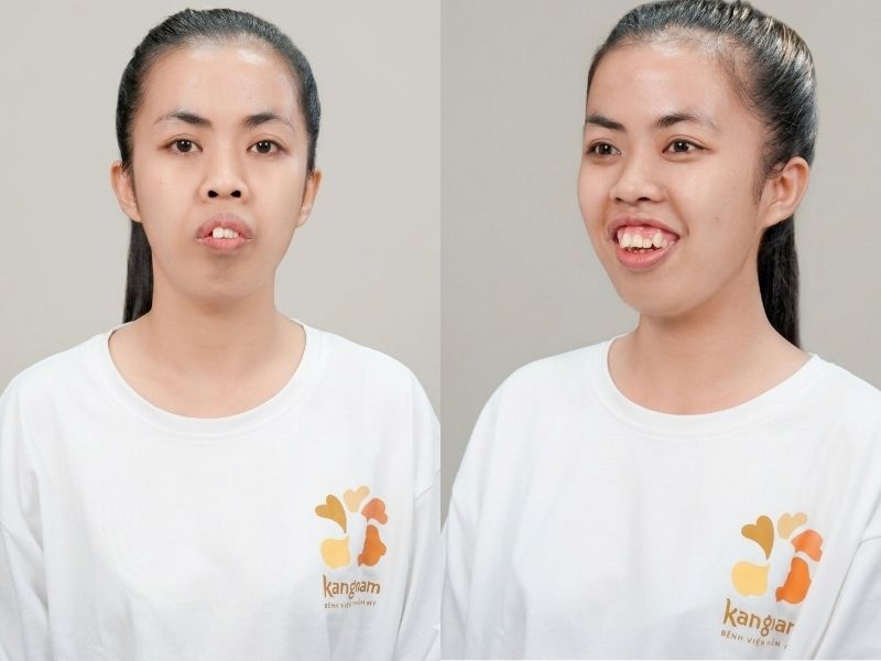 Khuyết điểm hàm hô nặng, răng mọc lộn xộn khiến My bị rè bỉu ngoại hình