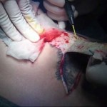 Cảnh báo nguy cơ từ phẫu thuật cắt bỏ hình xăm